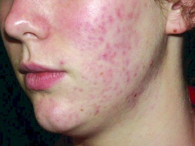 acne-health-niche