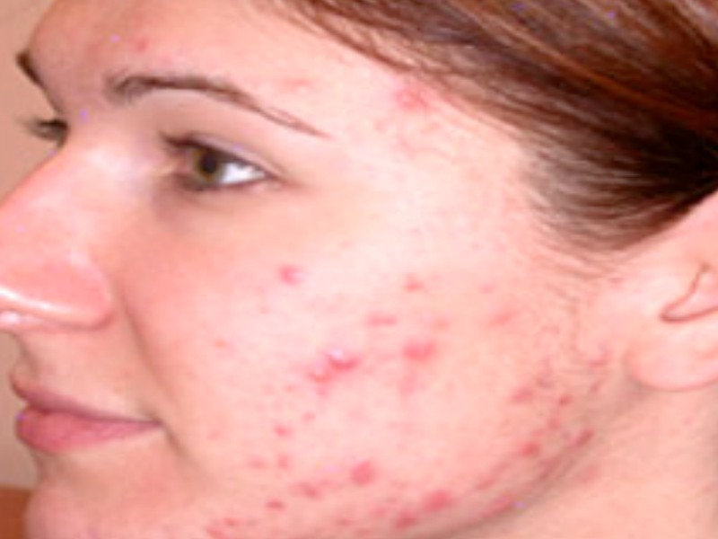common causes of acne