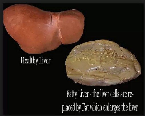 diffrence between a healthy liver and fat accumulated liver